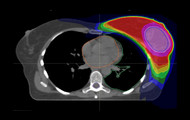 Kürzere Bestrahlungszeit bei Brustkrebs durch integrierte Boost-Bestrahlung: Der Bereich der höchsten verabreichten Strahlendosis ist rosa markiert. Quelle: Universitätsklinikum Heidelberg