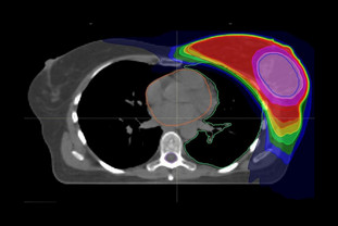Kürzere Bestrahlungszeit bei Brustkrebs durch integrierte Boost-Bestrahlung: Der Bereich der höchsten verabreichten Strahlendosis ist rosa markiert. Quelle: Universitätsklinikum Heidelberg
