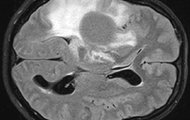 MRT-Aufnahme eines diffusen Glioms (oben) © Universitätsmedizin Mannheim