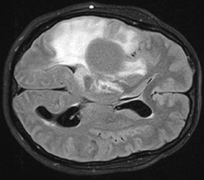 MRT-Aufnahme eines diffusen Glioms (oben) © Universitätsmedizin Mannheim