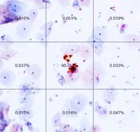 Objektträger aus einer automatisierten zytologischen Doppelfärbung. Das Bild in der Mitte (beschriftet mit 98,75 Prozent) zeigt ein positives Ergebnis. Copyright: Nicolas Wentzensen