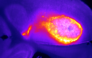 Angriff von Immunzellen (T-Zellen, gelb-orange) auf den Hirntumor (rosa). Im gesunden Hirngewebe (blau) tritt keine Immunaktivität auf. (Quelle: Universitätsklinikum Heidelberg)