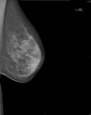 Mammographie - Responder Studie, Quelle: Universitätsklinikum Heidelberg (UKHD)