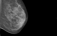 Mammographie - Responder Studie, Quelle: Universitätsklinikum Heidelberg (UKHD)