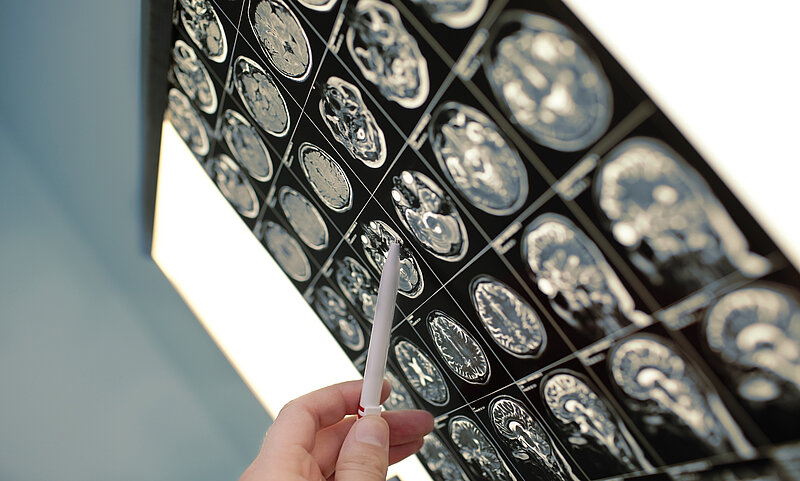 Krebs mit unbekanntem Primärtumor (CUP): Neue Leitlinie erschienen ...