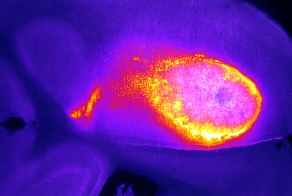 Angriff von Immunzellen (T-Zellen, gelb-orange) auf den Hirntumor (rosa). Im gesunden Hirngewebe (blau) tritt keine Immunaktivität auf. (Quelle: Universitätsklinikum Heidelberg)