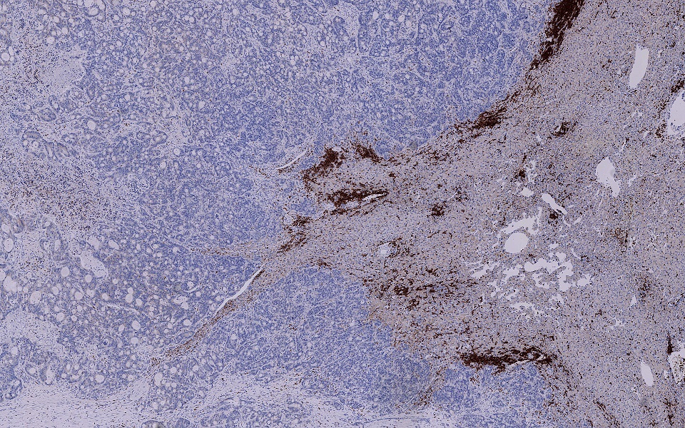 CD3-positive T-Zellen (braun) am invasiven Rand einer Lebermetastasierung bei Darmkrebs.